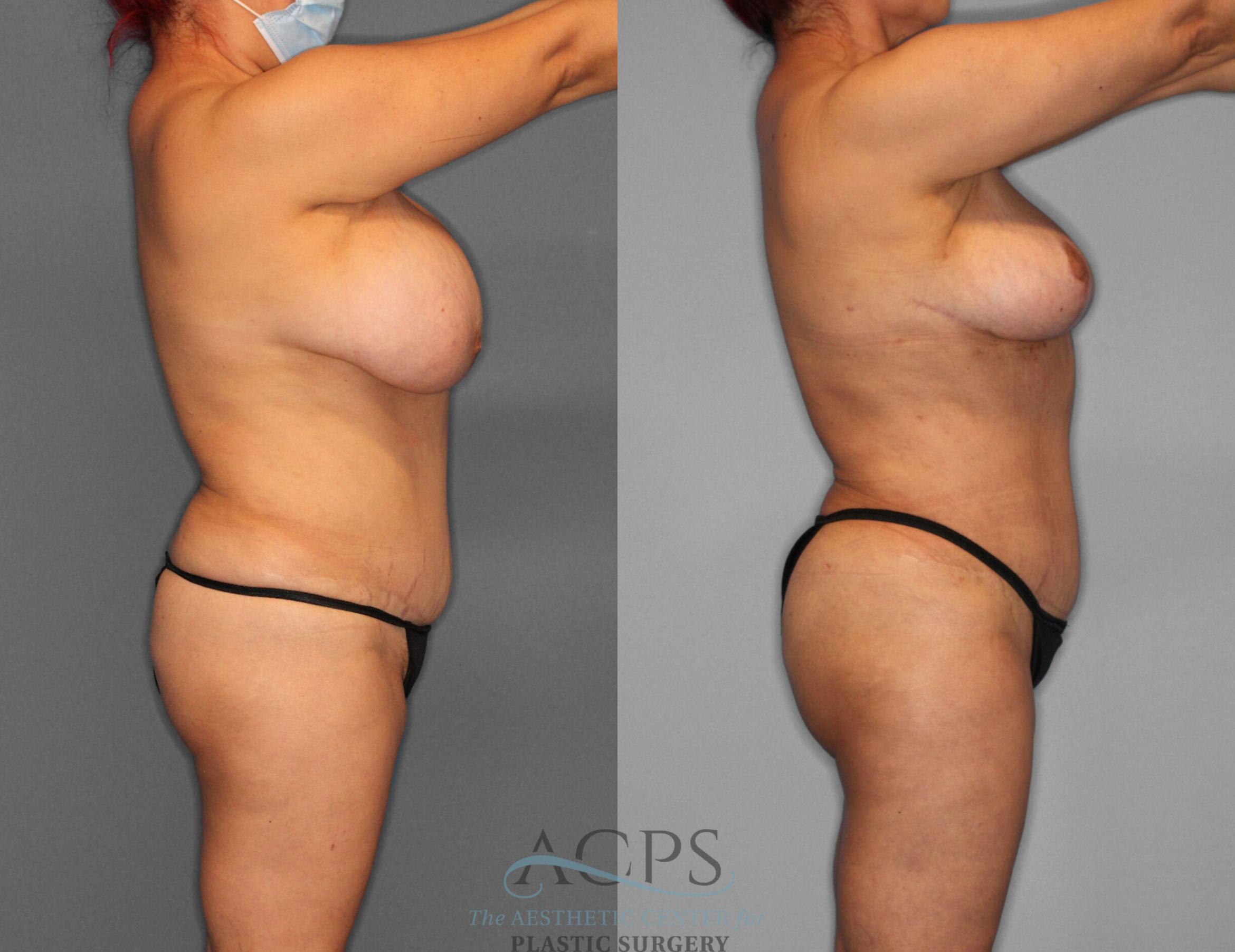 Before & After Brazilian Butt Lift (BBL) Case 403 Side View: View in Houston, TX