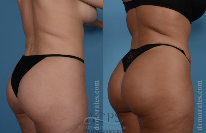 Before & After Brazilian Butt Lift (BBL) Case 404 Oblique View: View in Houston, TX