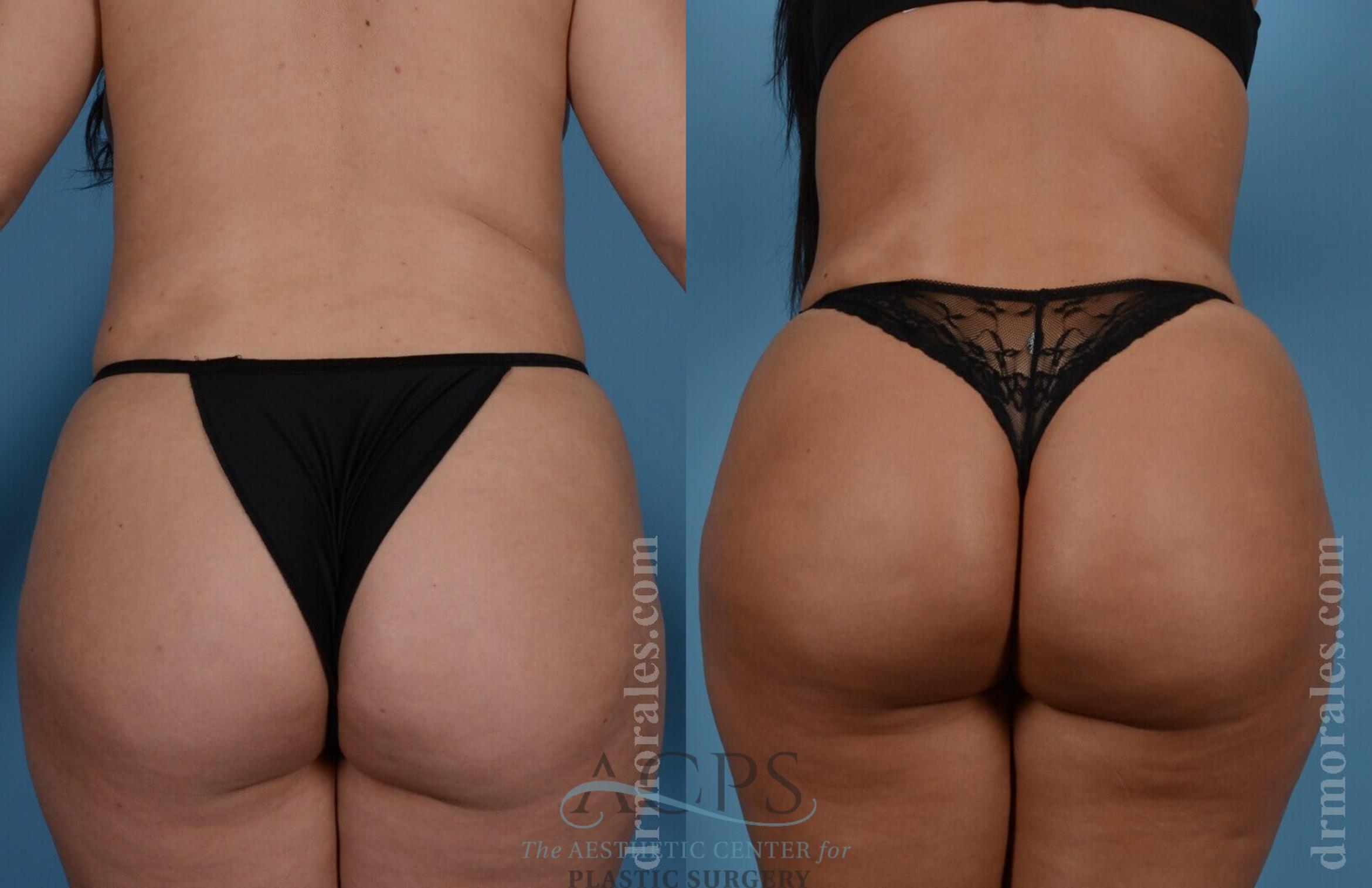 Before & After Brazilian Butt Lift (BBL) Case 404 Rear View: View in Houston, TX