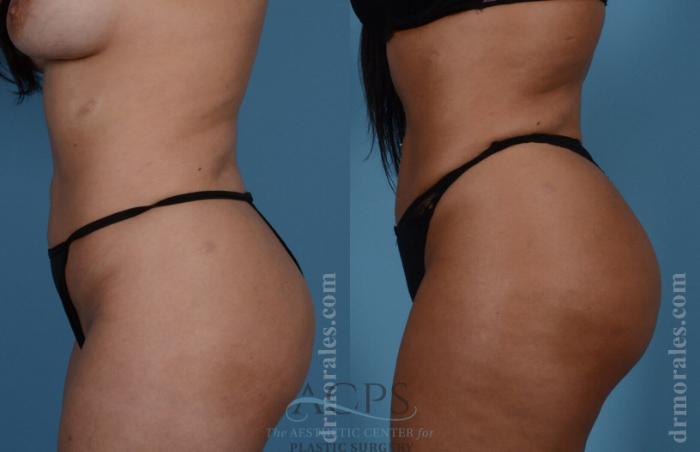 Before & After Brazilian Butt Lift (BBL) Case 404 Side View: View in Houston, TX