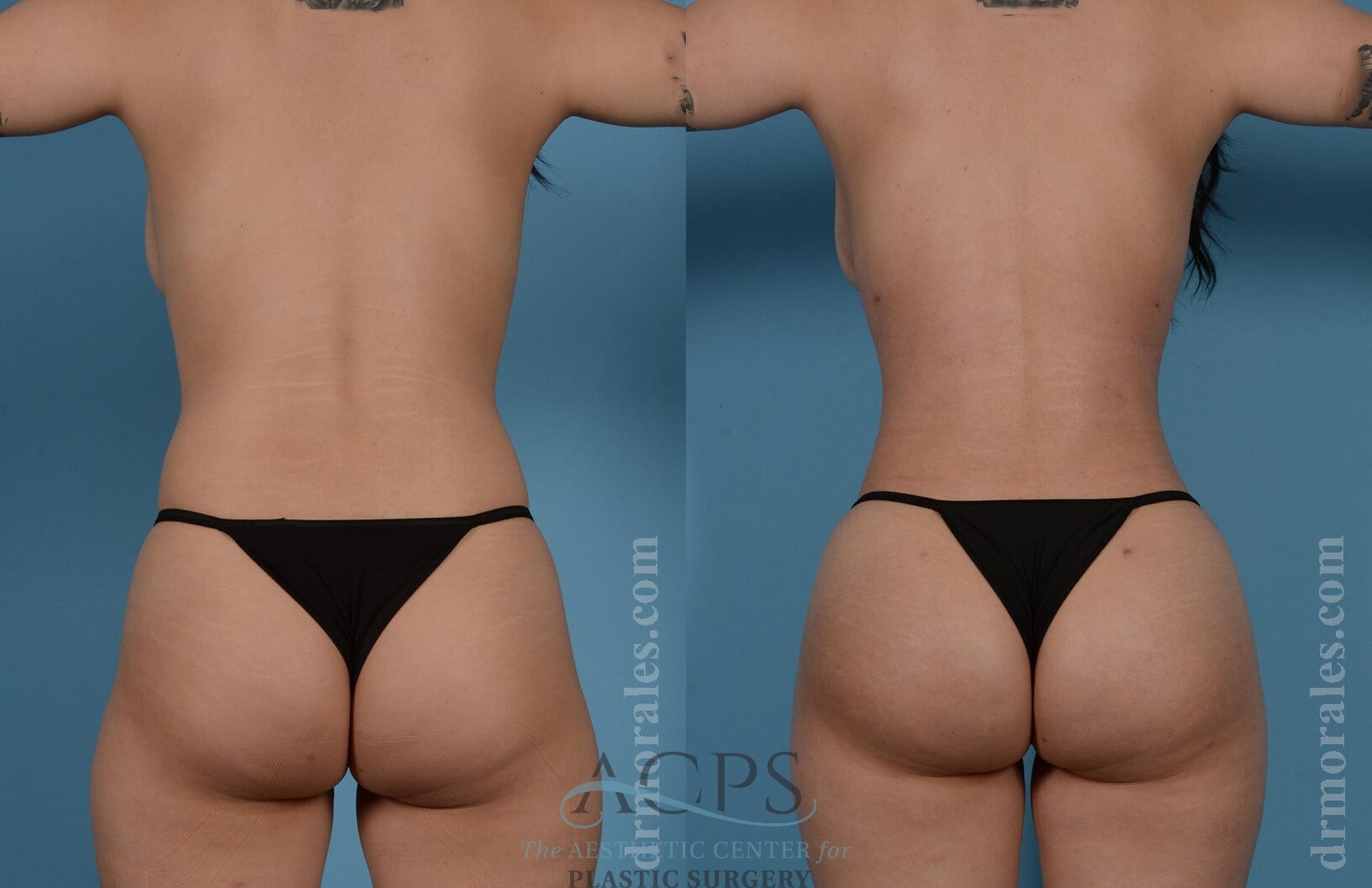 Before & After Brazilian Butt Lift (BBL) Case 405 Rear View: View in Houston, TX
