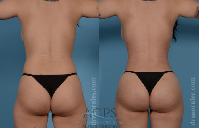 Before & After Brazilian Butt Lift (BBL) Case 405 Rear View: View in Houston, TX