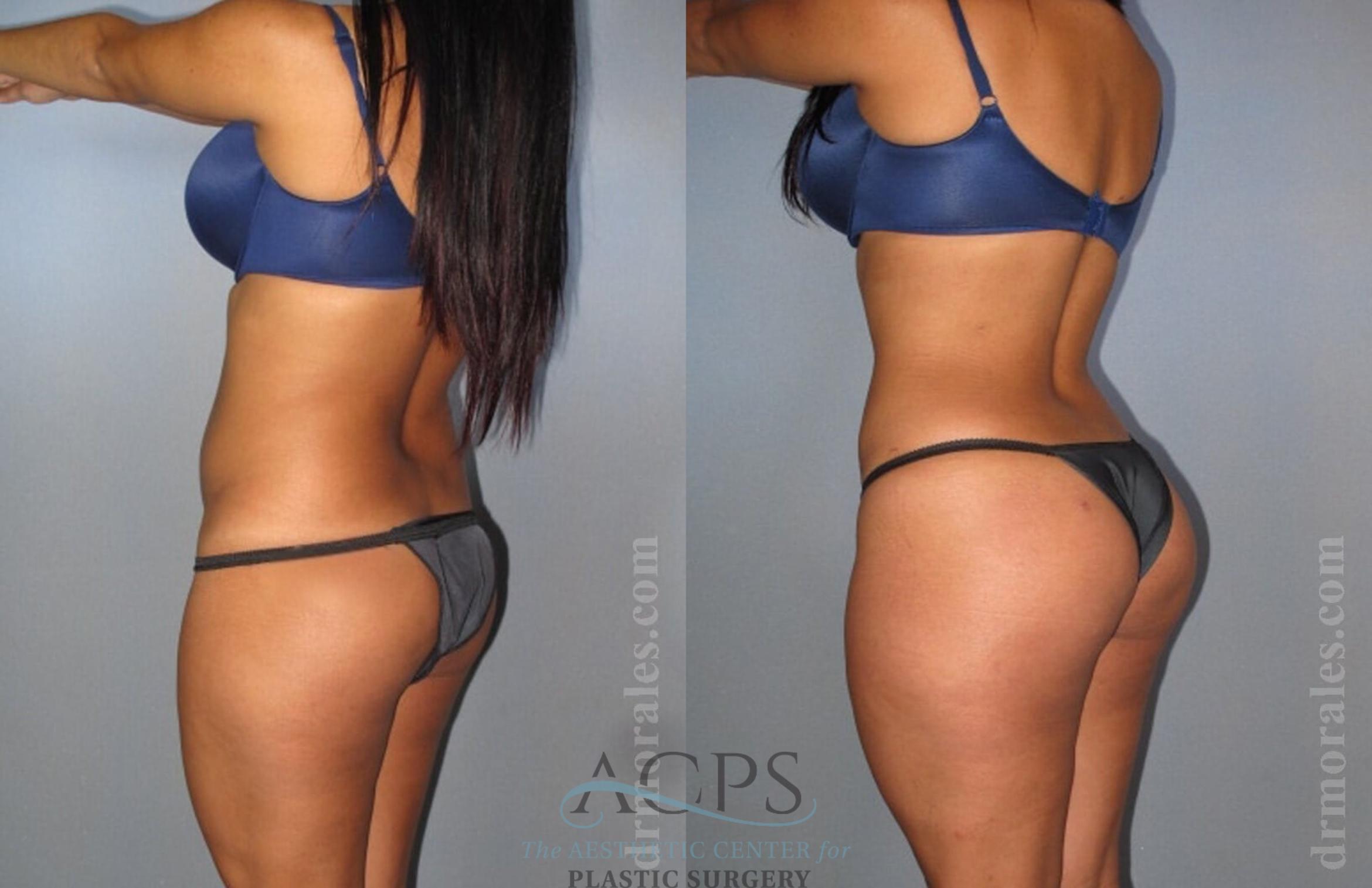 Before & After Brazilian Butt Lift (BBL) Case 406 Oblique View: View in Houston, TX