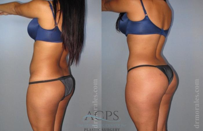 Before & After Brazilian Butt Lift (BBL) Case 406 Oblique View: View in Houston, TX