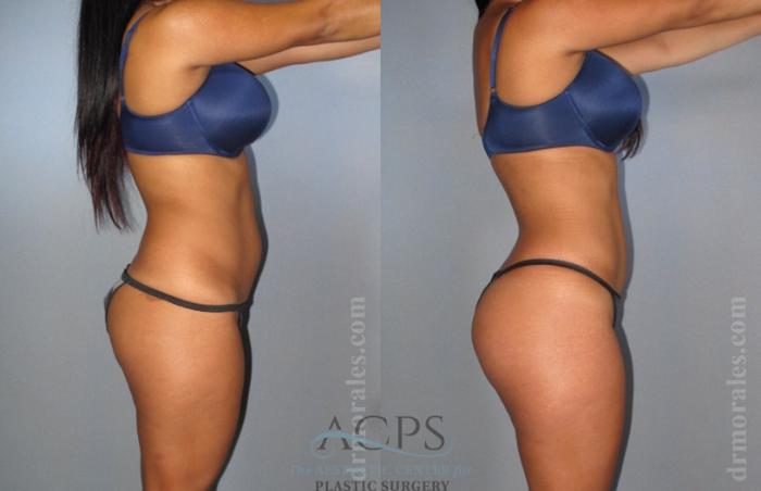 Before & After Brazilian Butt Lift (BBL) Case 406 Side View: View in Houston, TX