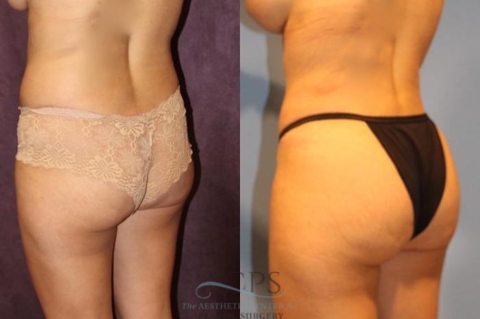 Before & After Brazilian Butt Lift (BBL) Case 407 Oblique View: View in Houston, TX