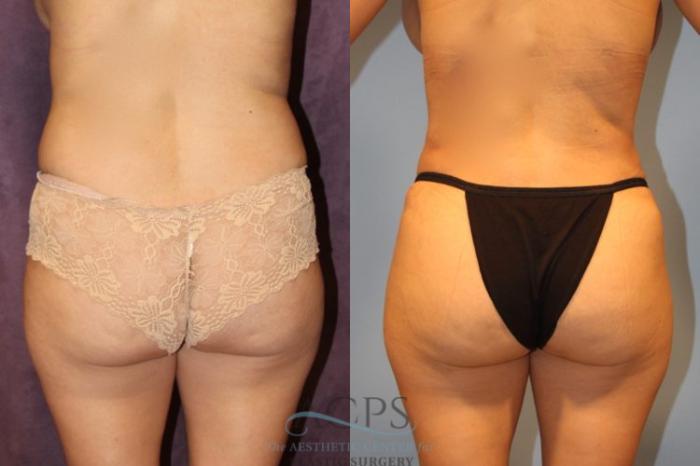 Before & After Brazilian Butt Lift (BBL) Case 407 Rear View: View in Houston, TX