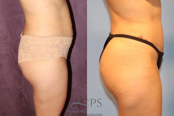 Before & After Brazilian Butt Lift (BBL) Case 407 Side View: View in Houston, TX