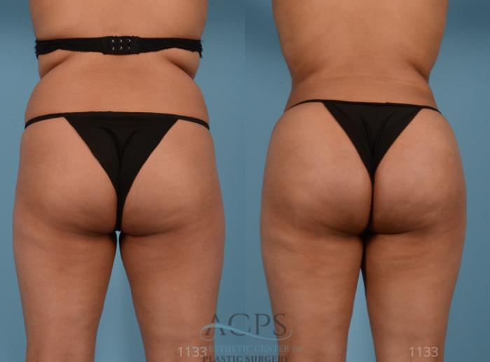 Before & After Brazilian Butt Lift (BBL) Case 408 Rear View: View in Houston, TX