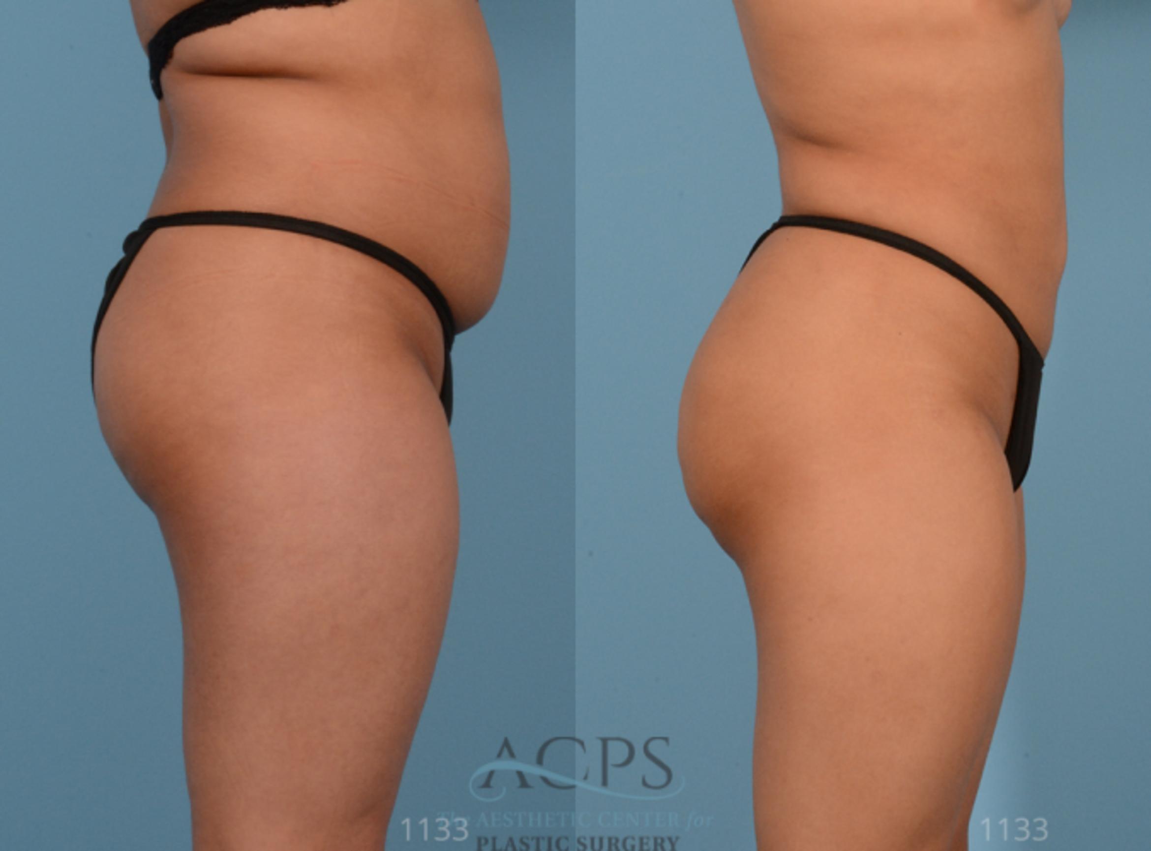Before & After Brazilian Butt Lift (BBL) Case 408 Side View: View in Houston, TX