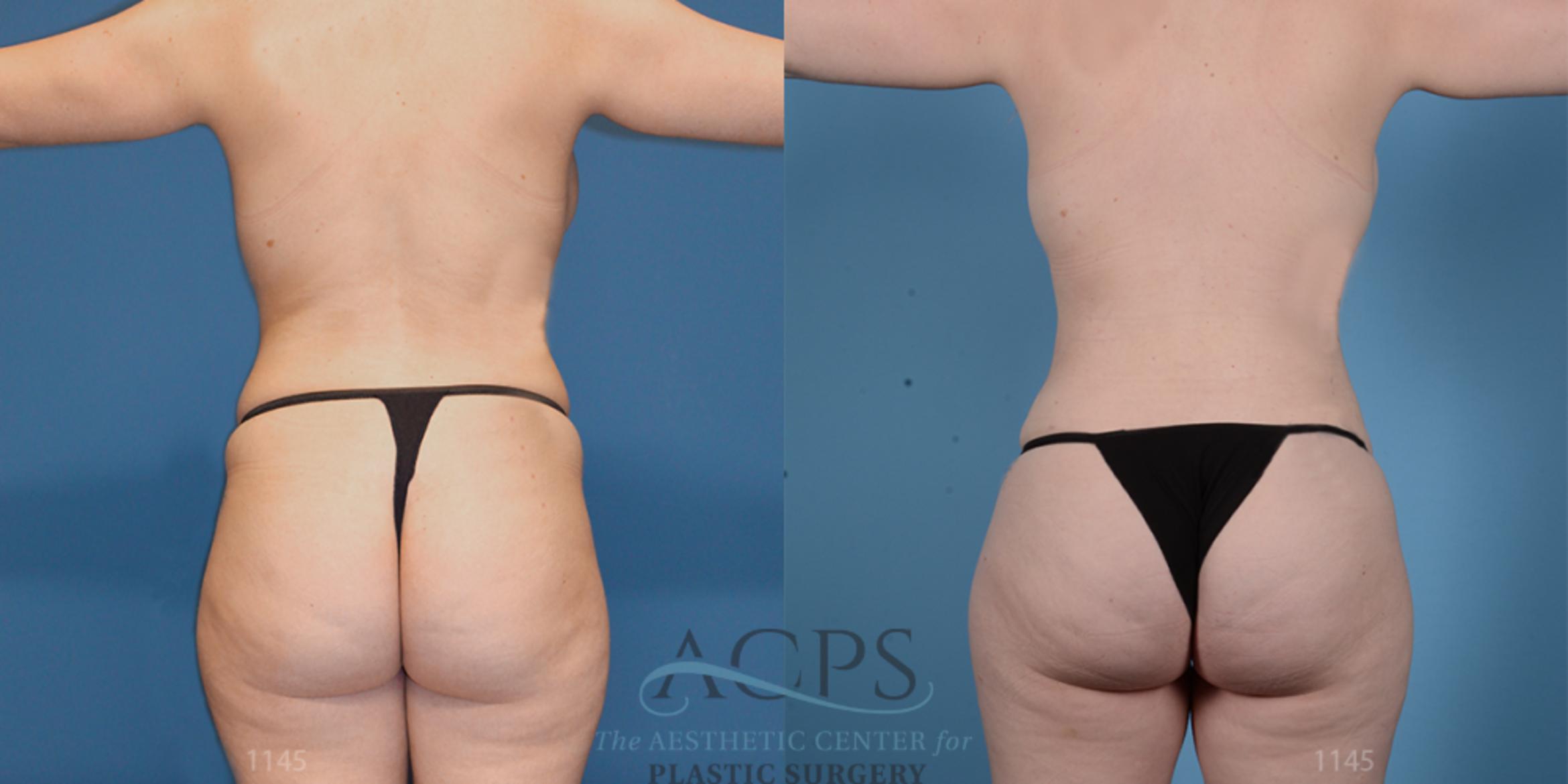 Before & After Brazilian Butt Lift (BBL) Case 409 Rear View: View in Houston, TX