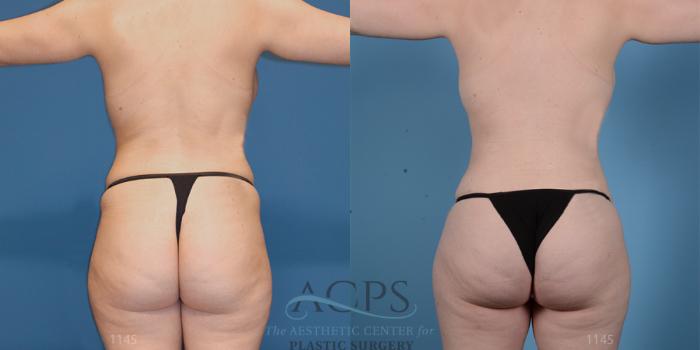 Before & After Brazilian Butt Lift (BBL) Case 409 Rear View: View in Houston, TX