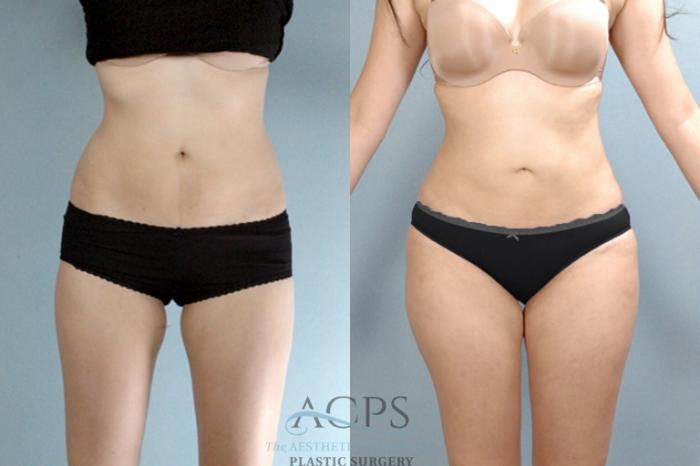 Before & After Brazilian Butt Lift (BBL) Case 410 Front View: View in Houston, TX