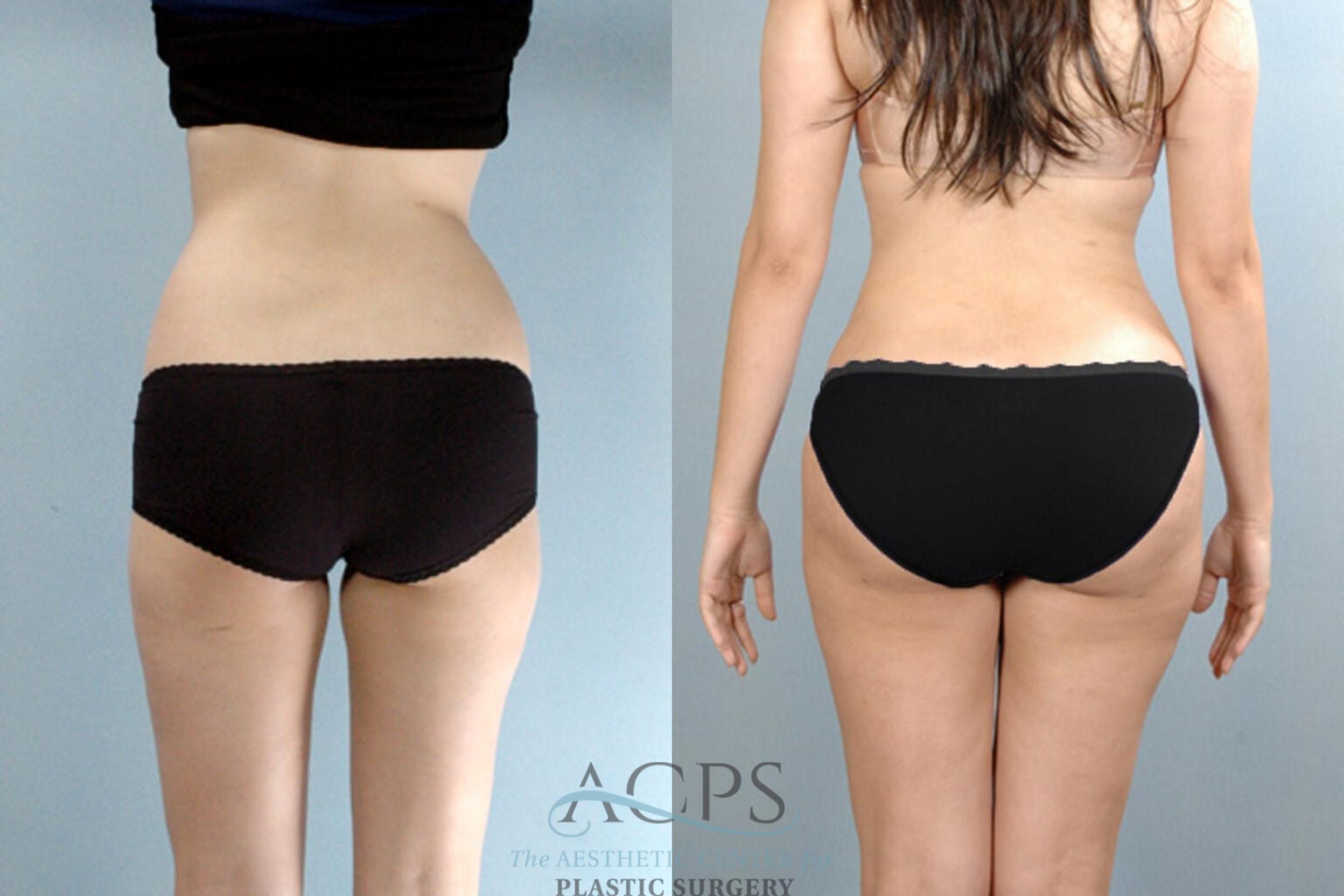 Before & After Brazilian Butt Lift (BBL) Case 410 Rear View: View in Houston, TX