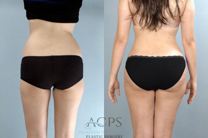 Before & After Brazilian Butt Lift (BBL) Case 410 Rear View: View in Houston, TX
