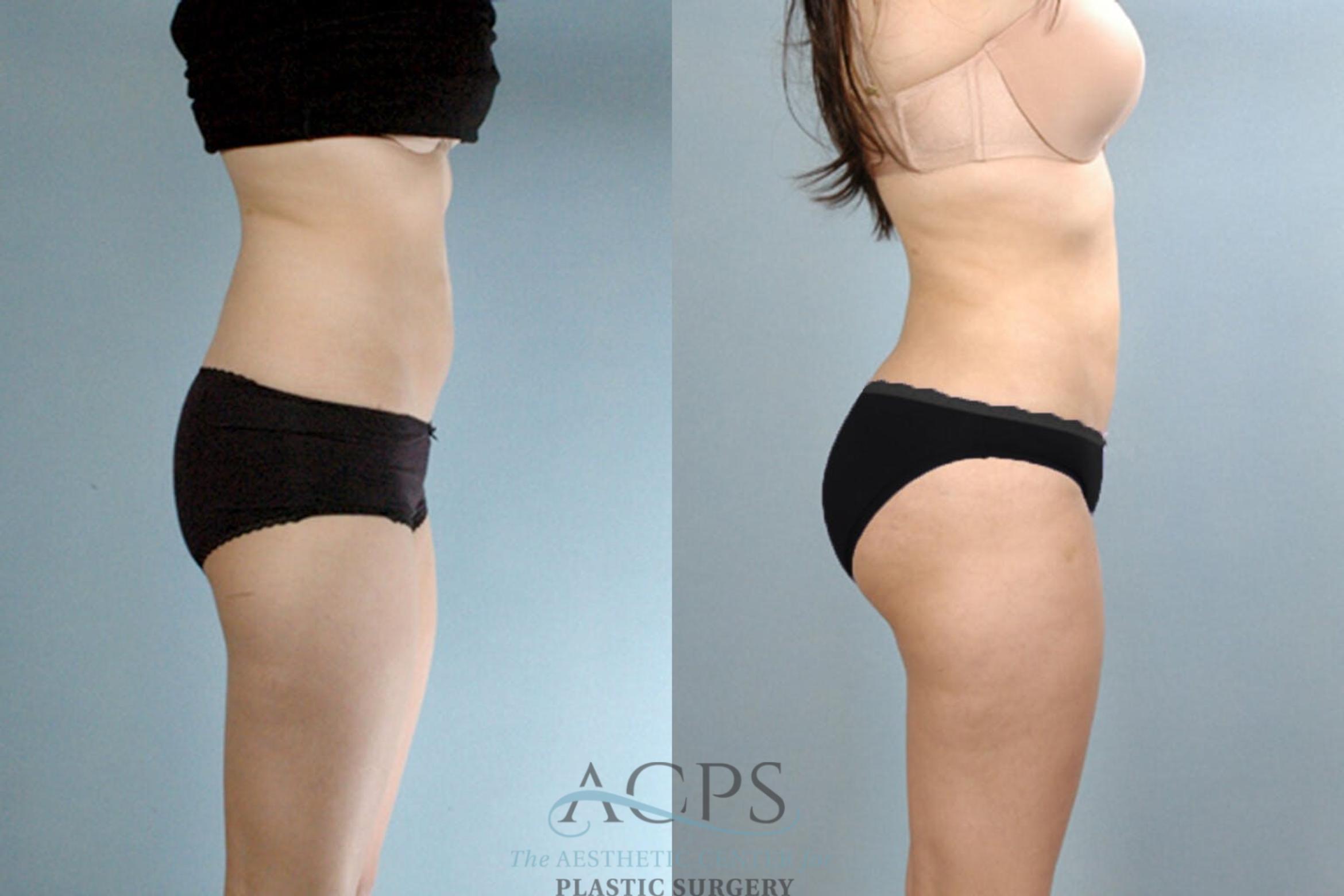 Before & After Brazilian Butt Lift (BBL) Case 410 Side View: View in Houston, TX