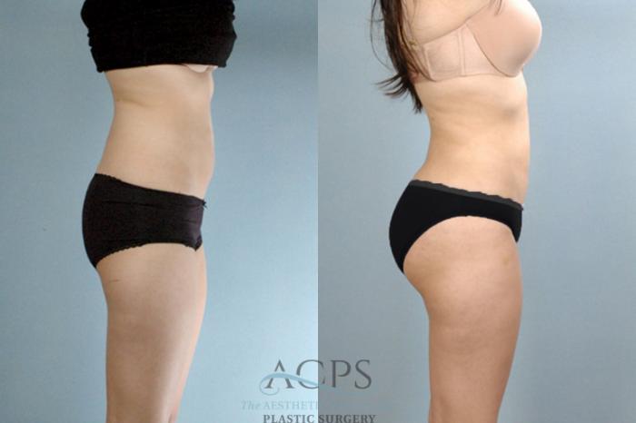 Before & After Brazilian Butt Lift (BBL) Case 410 Side View: View in Houston, TX