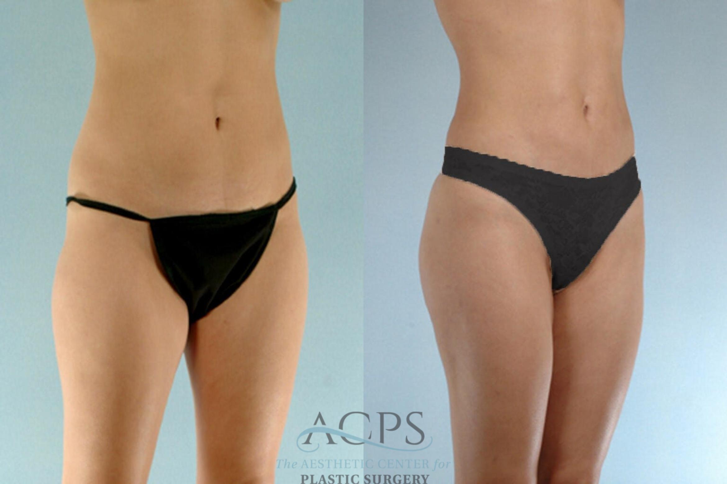 Before & After Brazilian Butt Lift (BBL) Case 411 Oblique View: View in Houston, TX