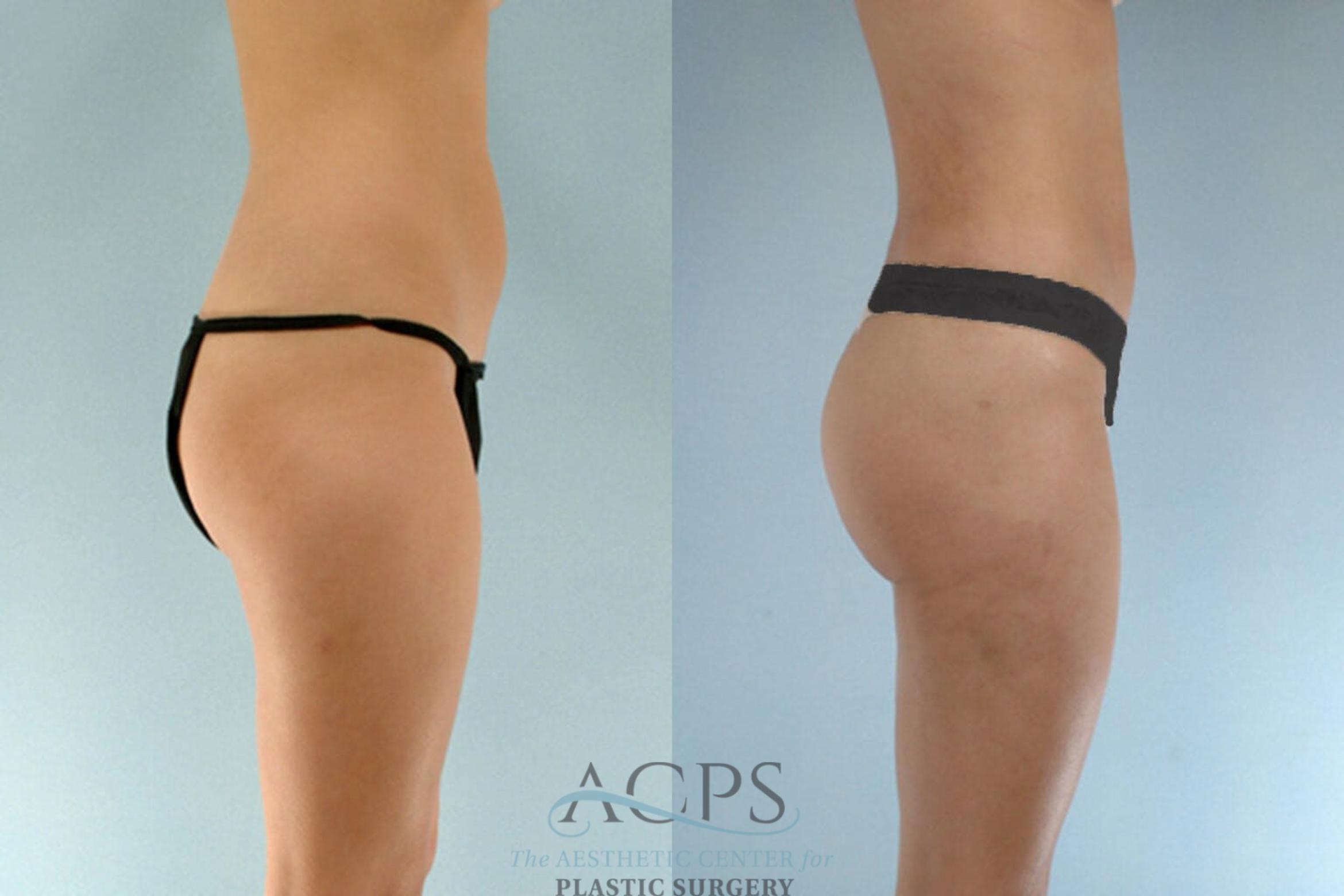 Before & After Brazilian Butt Lift (BBL) Case 411 Side View: View in Houston, TX
