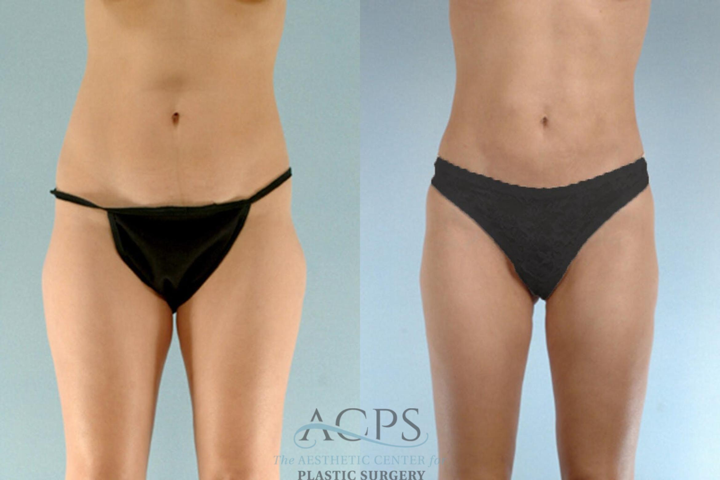 Before & After Brazilian Butt Lift (BBL) Case 411 View: View in Houston, TX