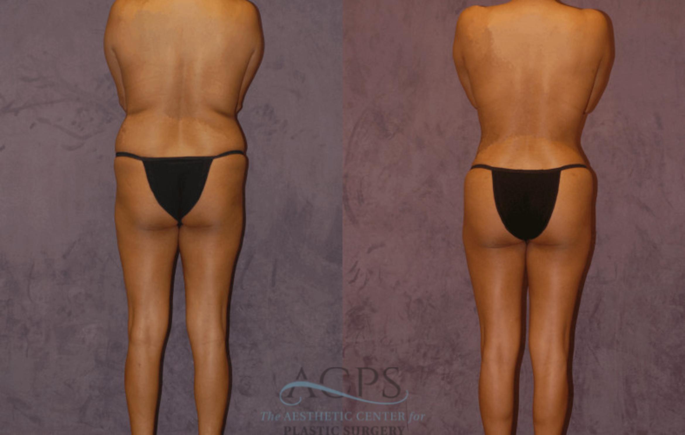 Before & After Brazilian Butt Lift (BBL) Case 415 Rear View: View in Houston, TX