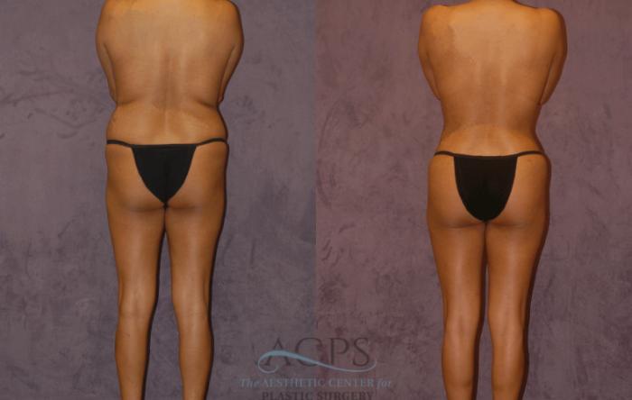 Before & After Brazilian Butt Lift (BBL) Case 415 Rear View: View in Houston, TX