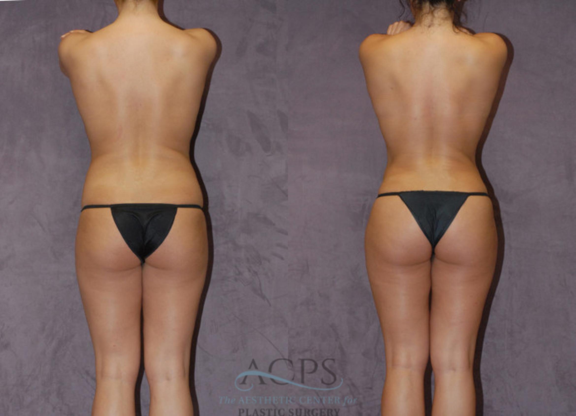 Before & After Brazilian Butt Lift (BBL) Case 417 Rear View: View in Houston, TX