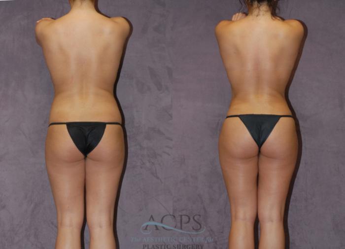 Before & After Brazilian Butt Lift (BBL) Case 417 Rear View: View in Houston, TX