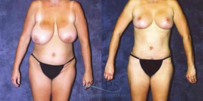 Before & After Breast Augmentation Case 418 Front View: View in Houston, TX