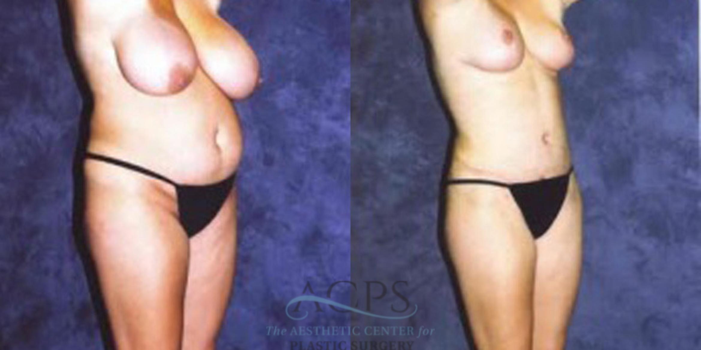 Before & After Breast Augmentation Case 418 Oblique View: View in Houston, TX