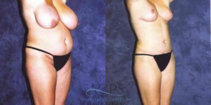 Before & After Breast Augmentation Case 418 Oblique View: View in Houston, TX