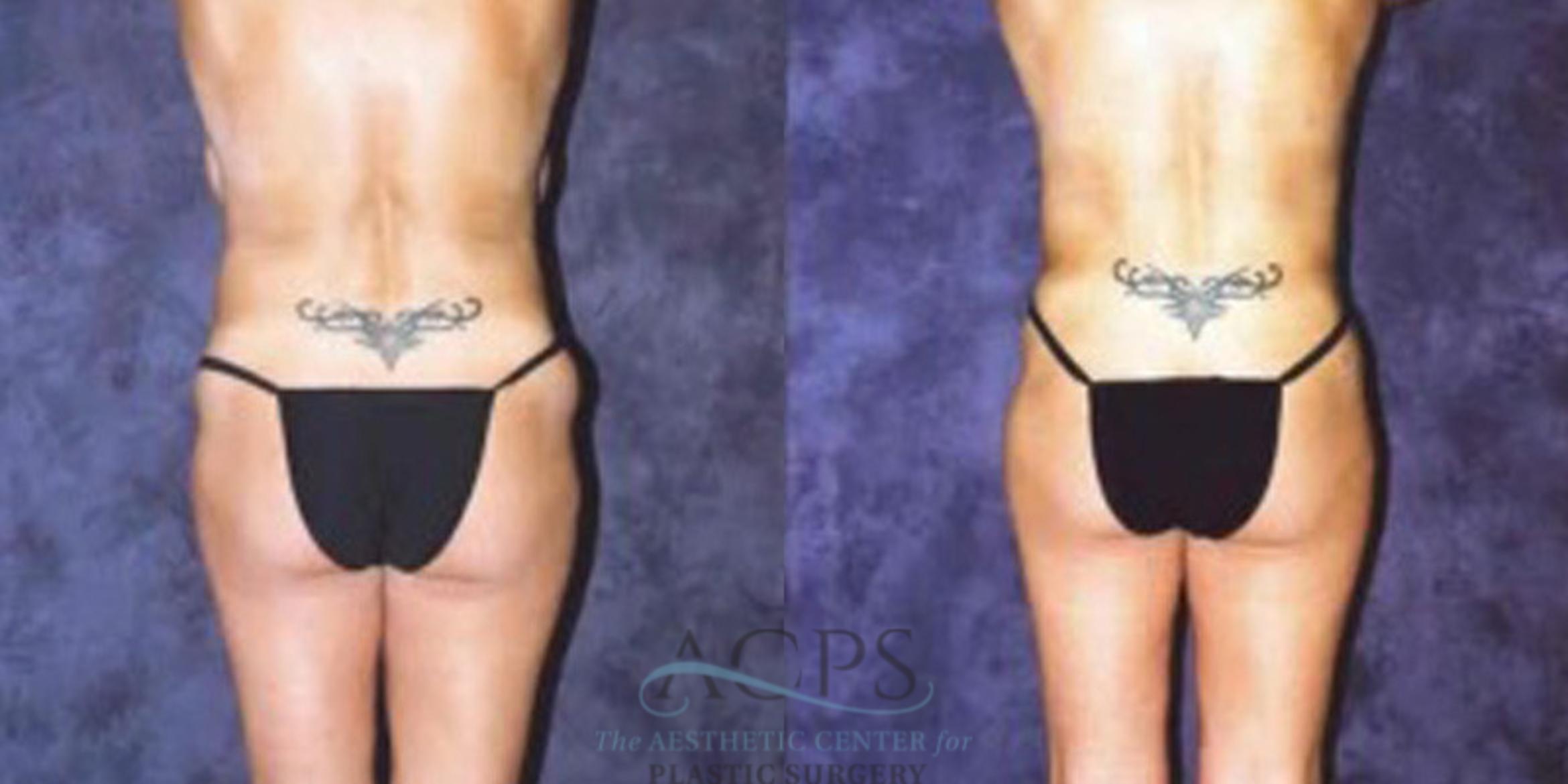 Before & After Breast Augmentation Case 418 Rear View: View in Houston, TX