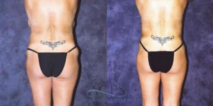 Before & After Breast Augmentation Case 418 Rear View: View in Houston, TX