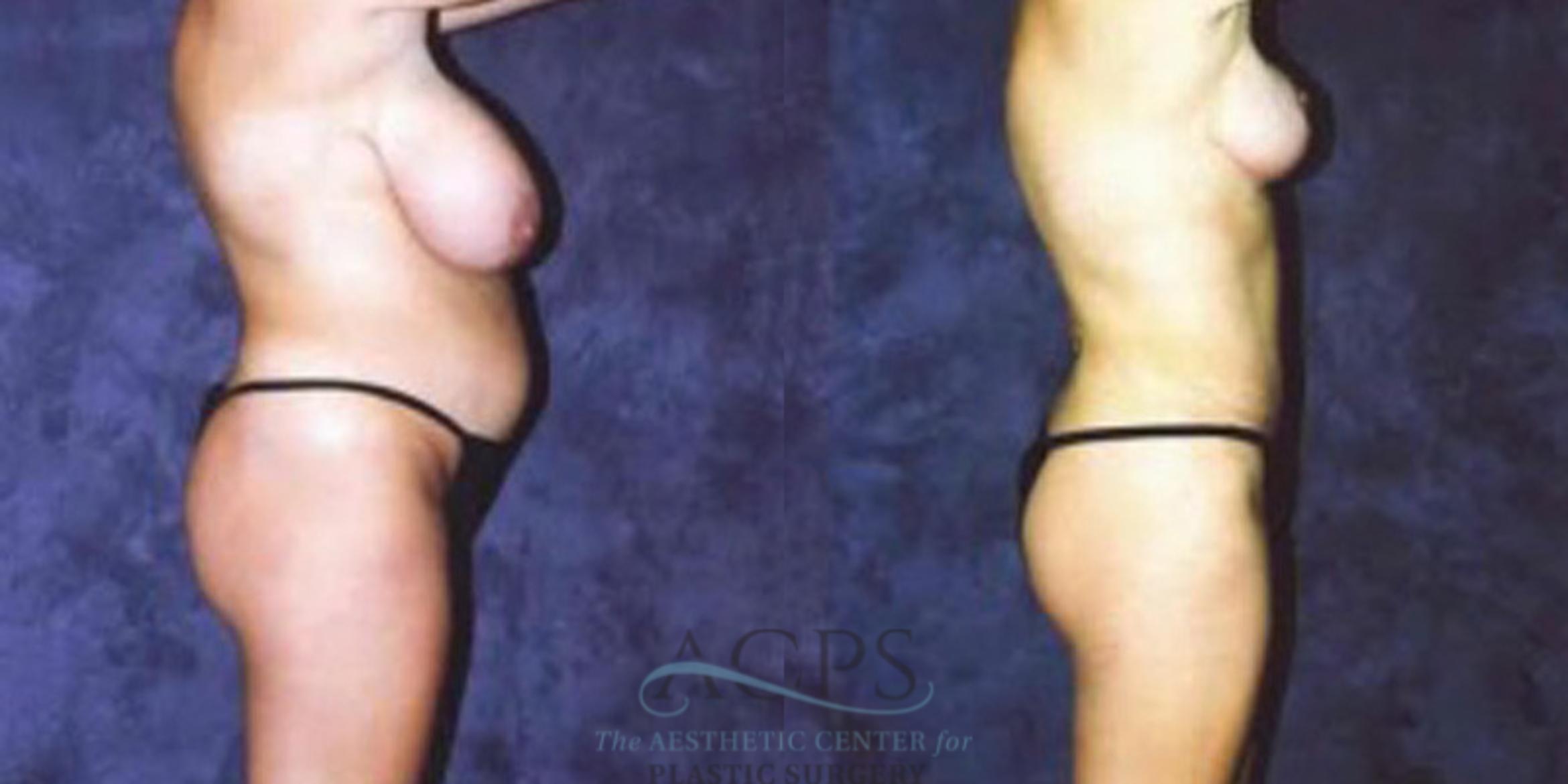 Before & After Breast Augmentation Case 418 Side View: View in Houston, TX