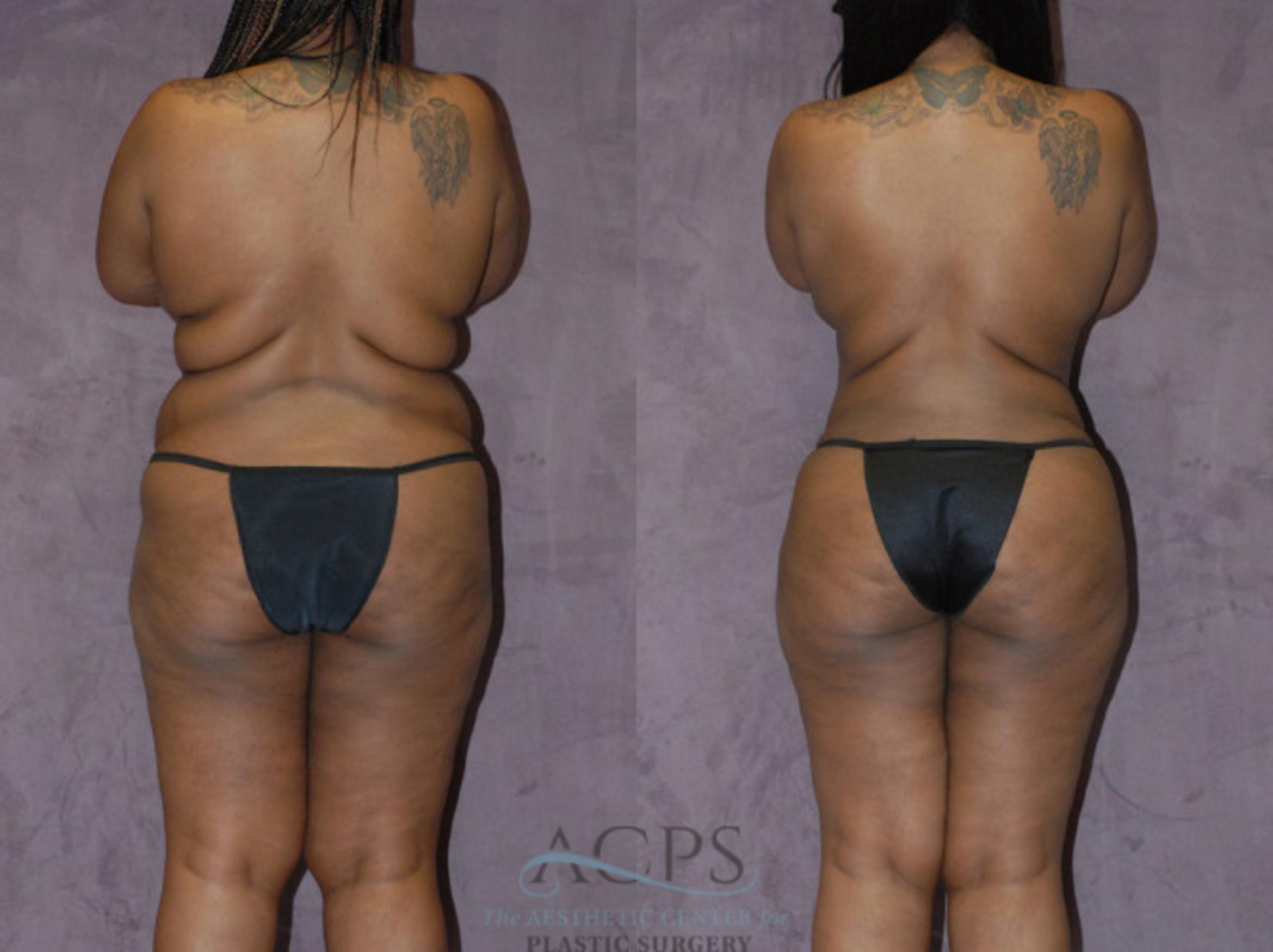 Before & After Brazilian Butt Lift (BBL) Case 419 Rear View: View in Houston, TX