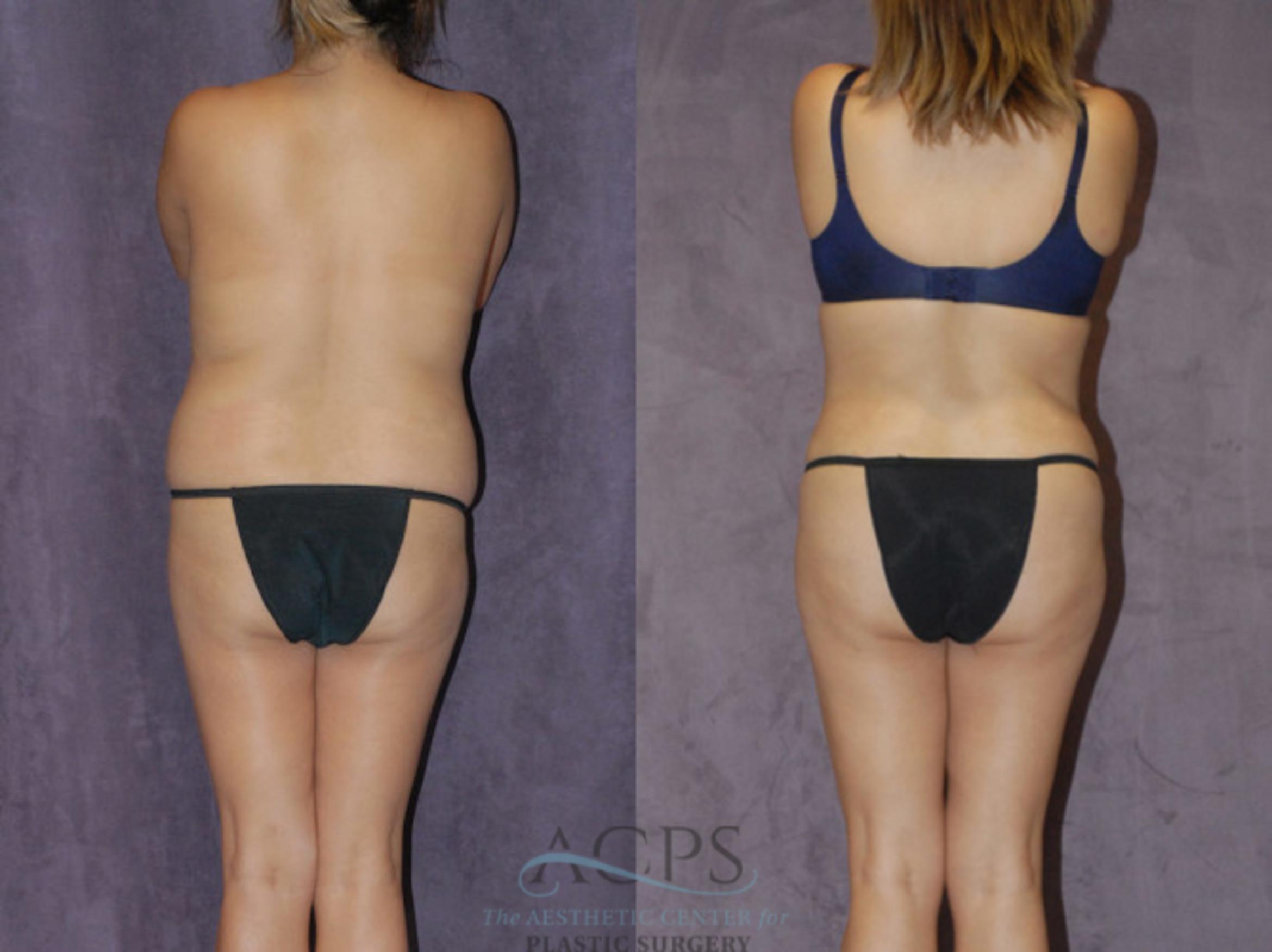Before & After Brazilian Butt Lift (BBL) Case 420 Rear View: View in Houston, TX