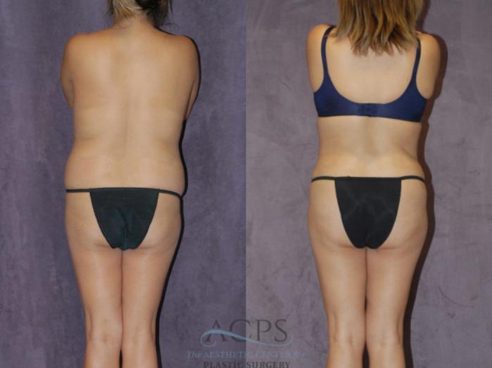 Before & After Brazilian Butt Lift (BBL) Case 420 Rear View: View in Houston, TX