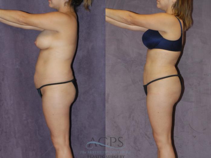 Before & After Brazilian Butt Lift (BBL) Case 420 Side View: View in Houston, TX