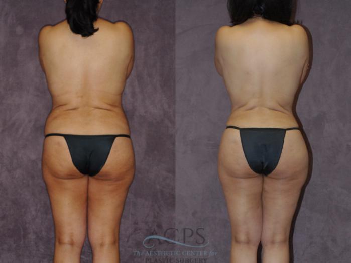 Before & After Brazilian Butt Lift (BBL) Case 421 Rear View: View in Houston, TX