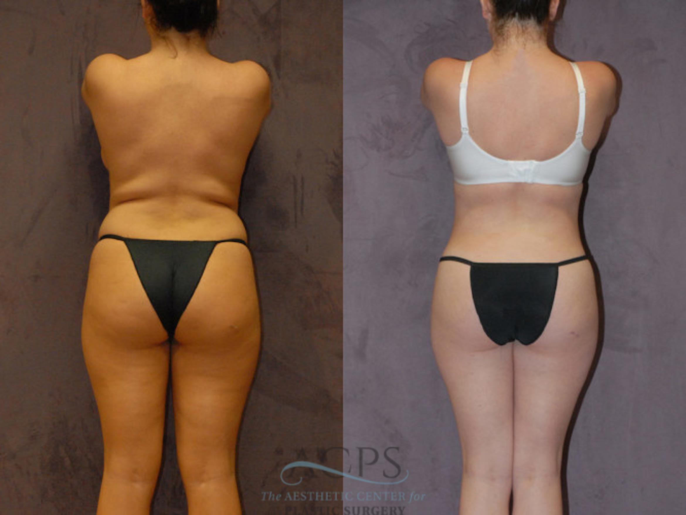 Before & After Brazilian Butt Lift (BBL) Case 422 Rear View: View in Houston, TX