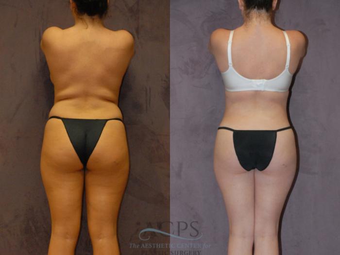 Before & After Brazilian Butt Lift (BBL) Case 422 Rear View: View in Houston, TX