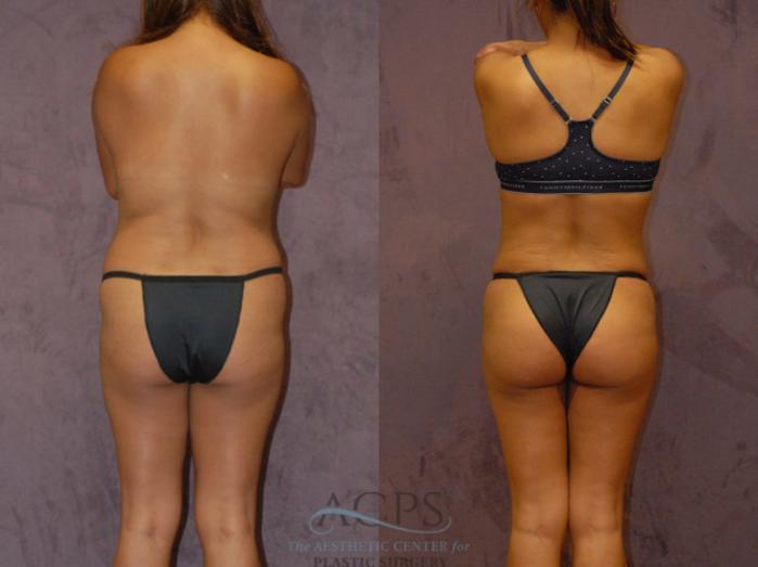 Before & After Brazilian Butt Lift (BBL) Case 423 Rear View: View in Houston, TX