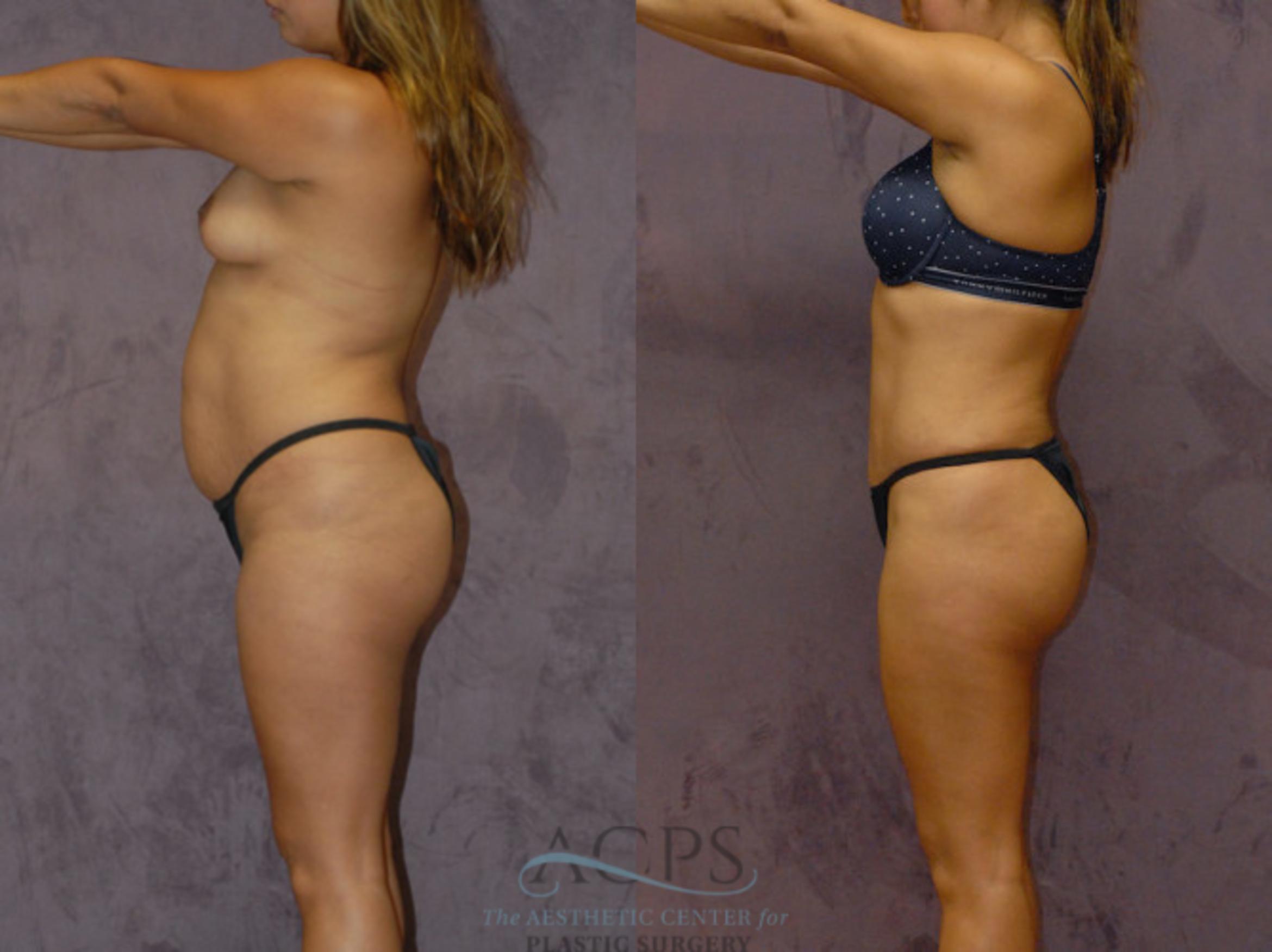Before & After Brazilian Butt Lift (BBL) Case 423 Side View: View in Houston, TX