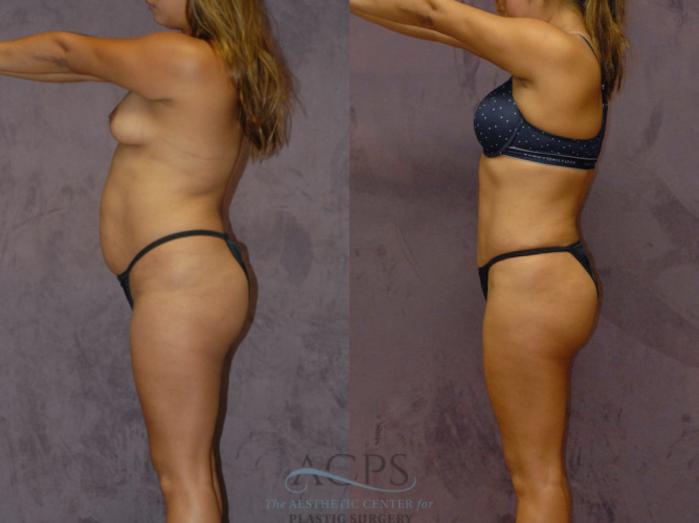 Before & After Brazilian Butt Lift (BBL) Case 423 Side View: View in Houston, TX