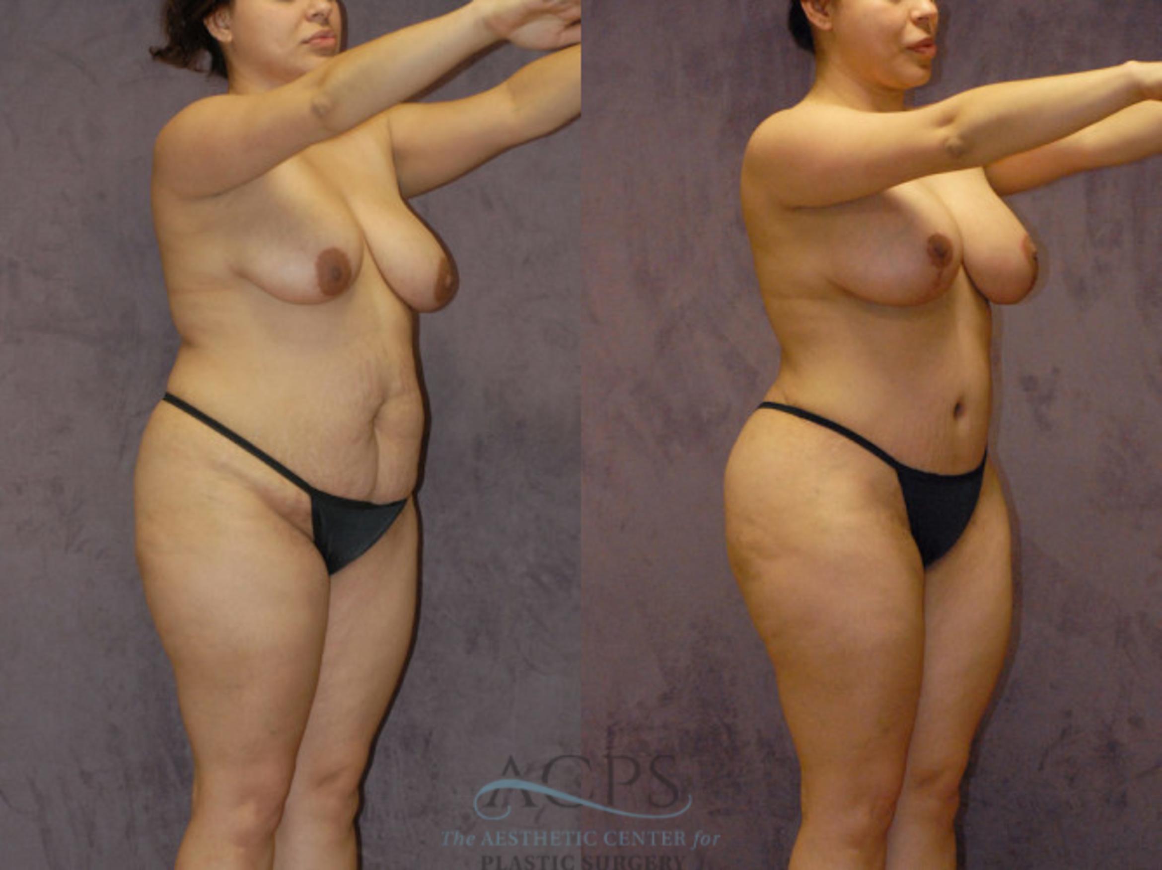 Before & After Brazilian Butt Lift (BBL) Case 424 Oblique View: View in Houston, TX