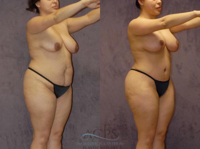 Before & After Brazilian Butt Lift (BBL) Case 424 Oblique View: View in Houston, TX