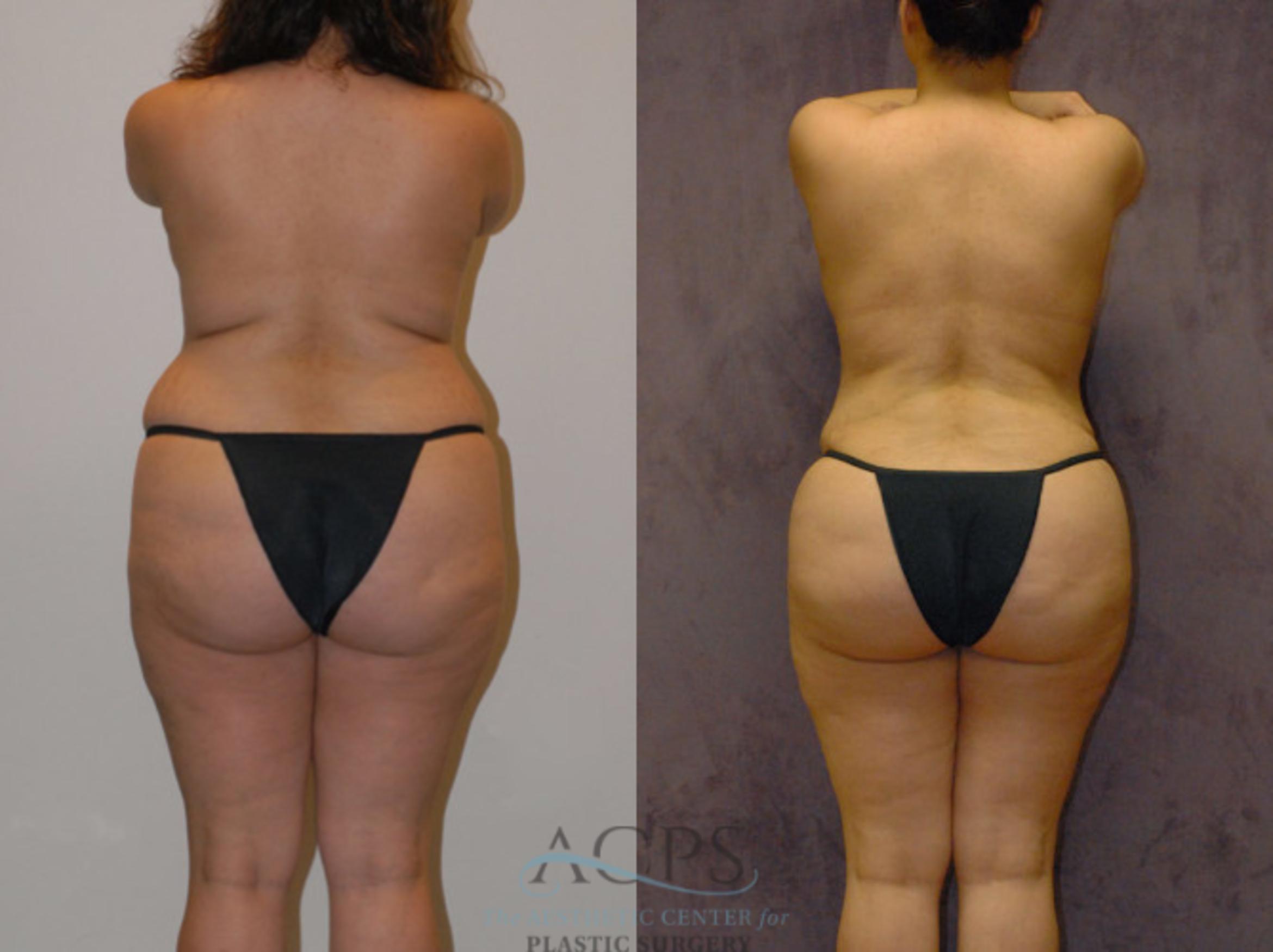 Before & After Brazilian Butt Lift (BBL) Case 424 Rear View: View in Houston, TX