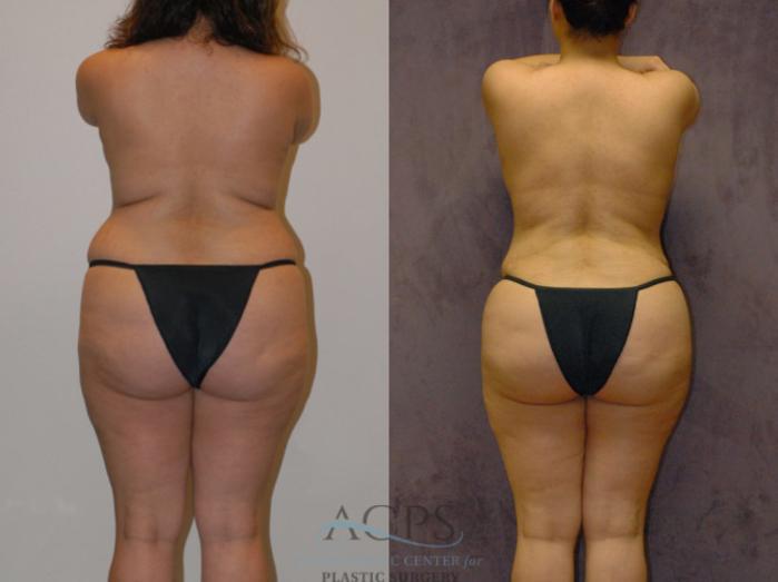 Before & After Brazilian Butt Lift (BBL) Case 424 Rear View: View in Houston, TX