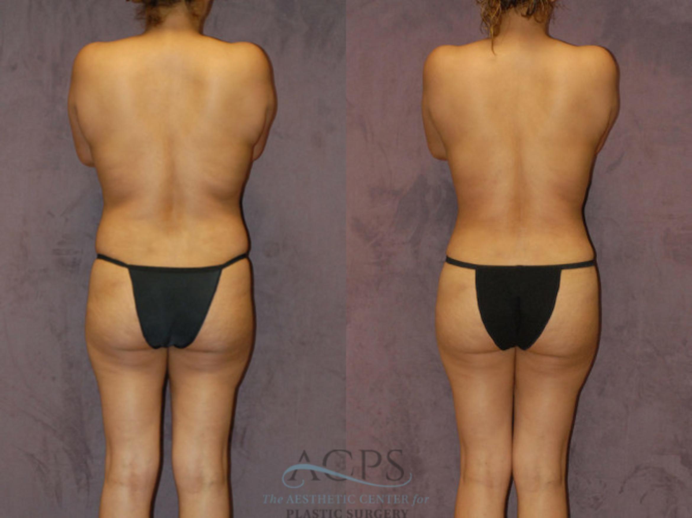 Before & After Brazilian Butt Lift (BBL) Case 425 Rear View: View in Houston, TX