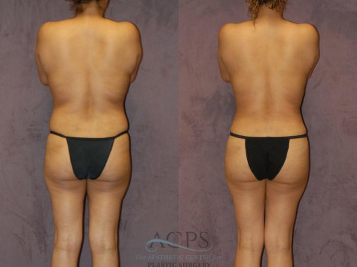 Before & After Brazilian Butt Lift (BBL) Case 425 Rear View: View in Houston, TX